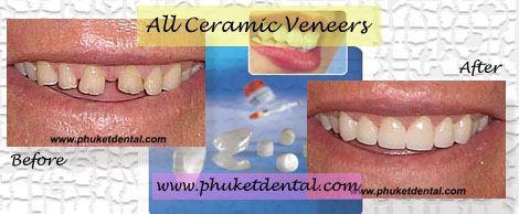 Ceramic/Porcelain Veneers by Phuket Dentist at Phuket Dental Clinic in Phuket,Thailand